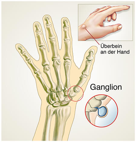 Ganglion
