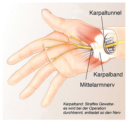 Karpaltunnelsyndrom