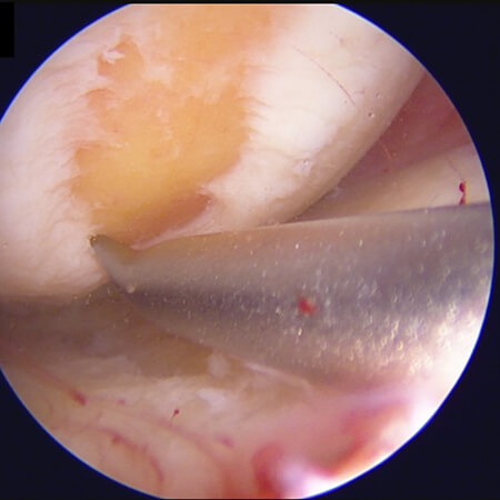 Setzen der ersten Fracturierung mit dem Knochenpick.