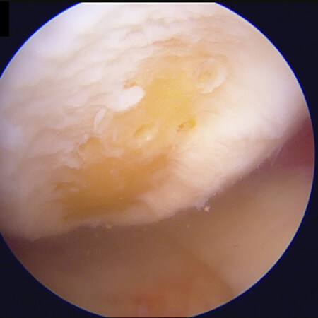 Fertige Microfracturierung, Löcher über den Defekt verteilt, damit der neue Faserknorpel wachsen kann.