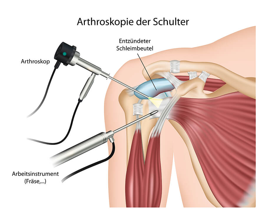 Arthroskopie der Schulter